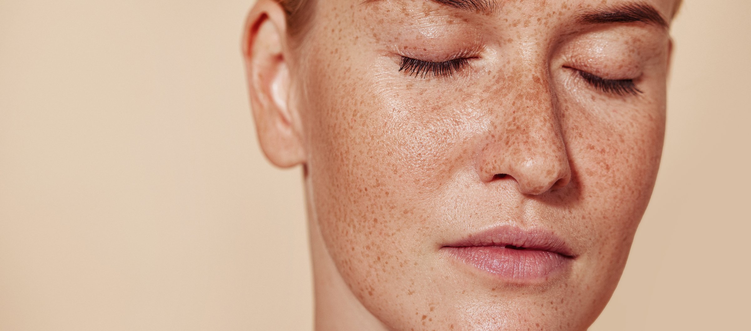 Moles, sunspots and freckles: What they are and when to be concerned